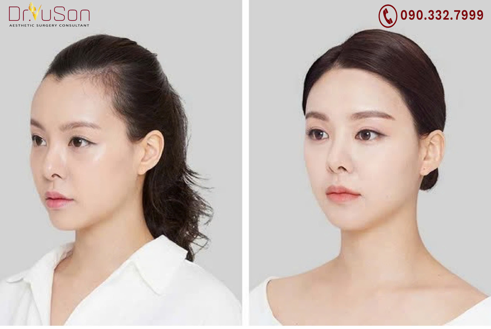 Trán thấp nỗi tự ti khó nói của đàn ông tuổi 30